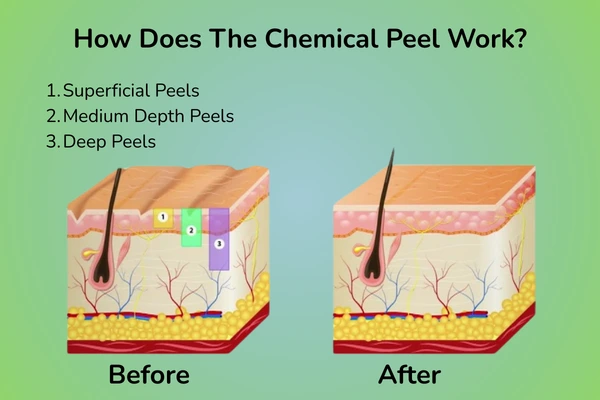 How the chemical peel works?