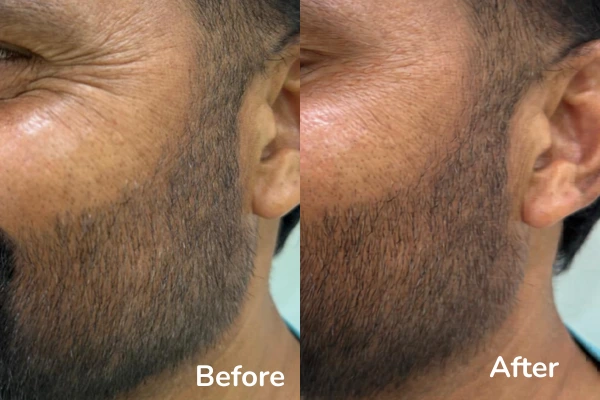 Before and after results of Evenly Skin and Hair Clinic
