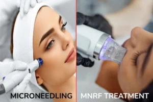MNRF vs Micro needling treatment