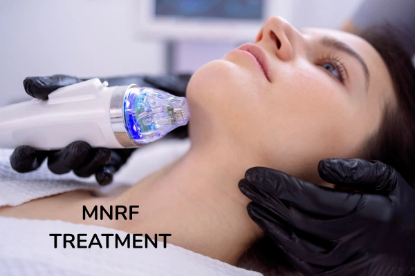 What is MNRF treatment and a women taking the treatment