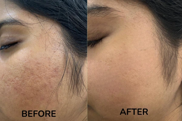 Before and after images of MNRF treatment