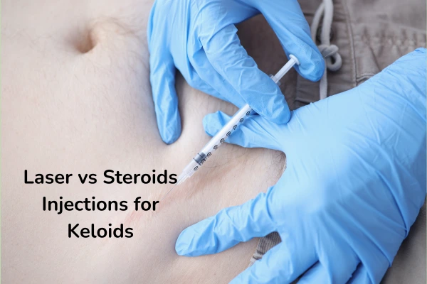 An image differentiating laser and intralesional steroid injections on keloids