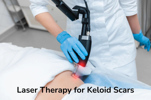 Laser treatment for keloid scars