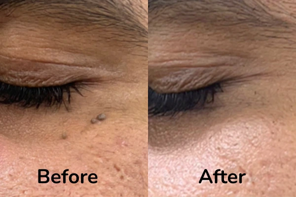 Before and after images of RF ablation