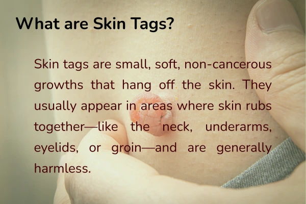 Skin tags