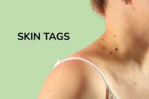 A women with skin tags on her neck area