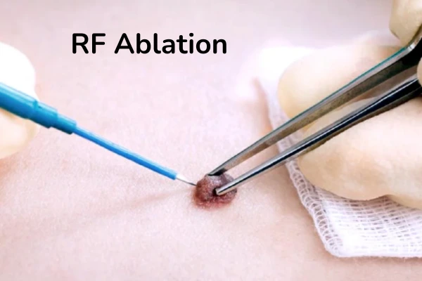 RF ablation treatment