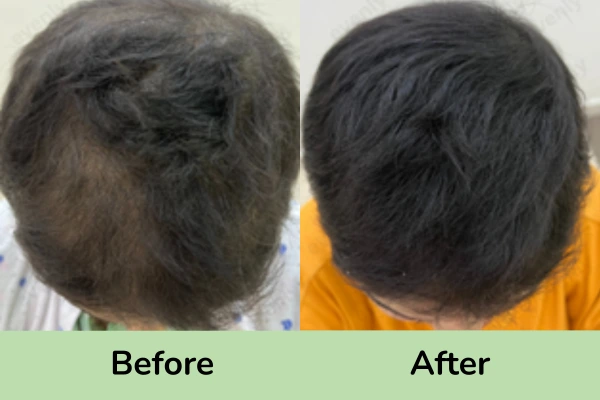 Before and after images of hair loss or thinning treatment