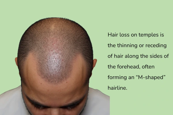 What is hair loss on temples and how does it appear