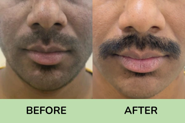 Before and after images of Evenly clinic, pigmentation treatment