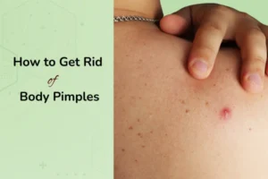 A middle aged men with a body acne on his back