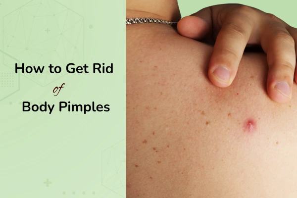 A middle aged men with a body acne on his back