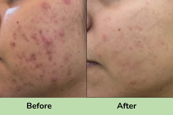 Before and after images of Acne treatment