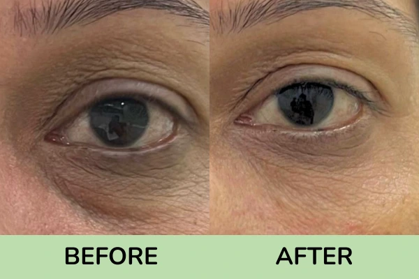 Before and after results of fillers of under eyes