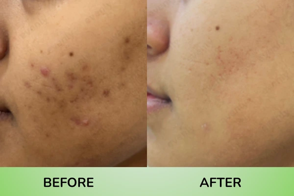 Before and after results of black spots treatment