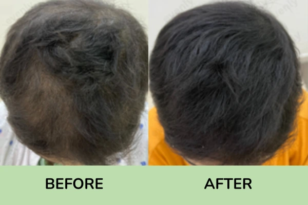 Before and after results of hair fall treatment