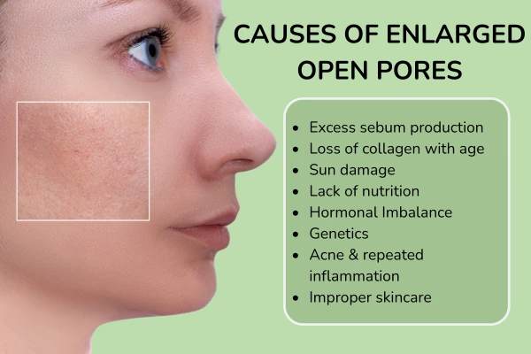 Causes of enlarged pores on face