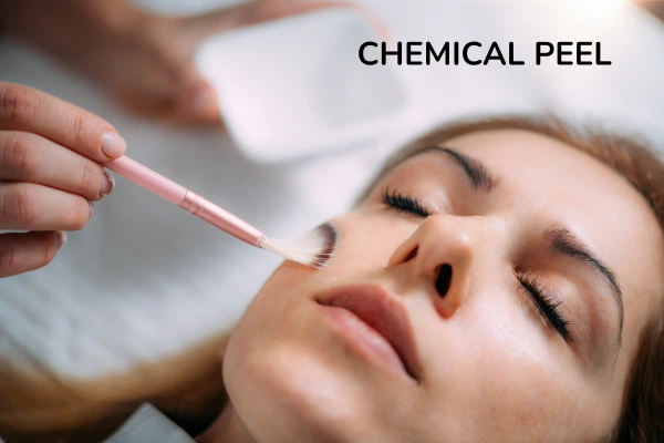 Chemical peel treatment