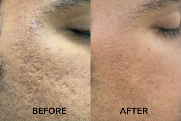 Before and after images of open pores treatment