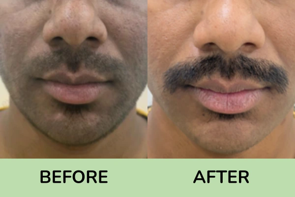 Before and after images of detan facial treatment