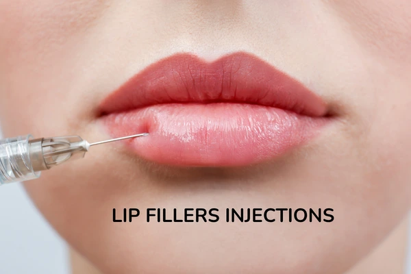 Lip Fillers Injections