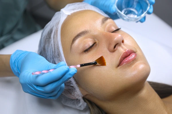 Chemical peel treatment