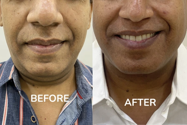 before and after images of hifu treatment