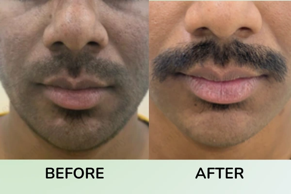 Before and after images of combinational treatment