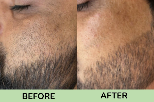 Before and after images of beard shaping
