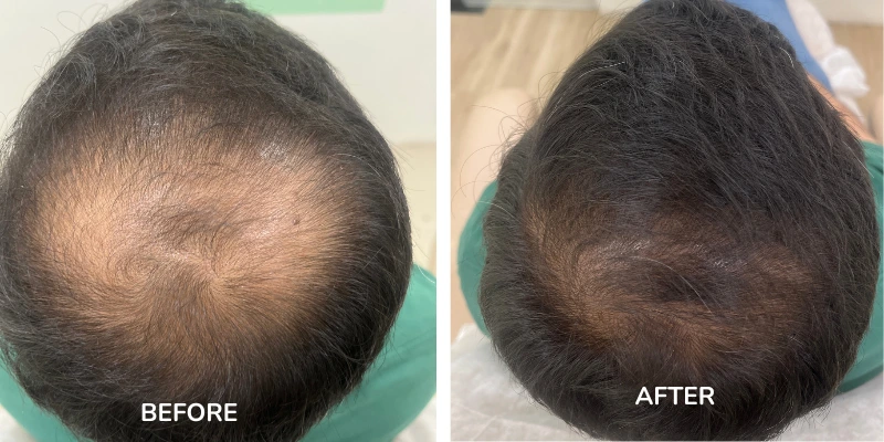Before and after images of hair loss treatments