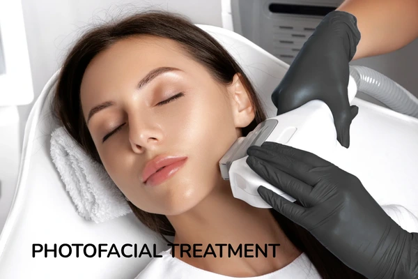 Photofacial treatment