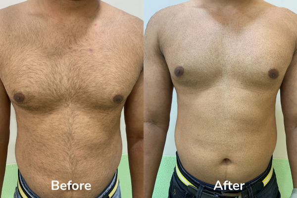 Before and after images of laser hair reduction