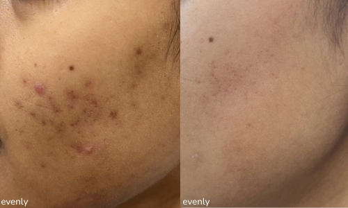 Before and after images of microneedling treatment