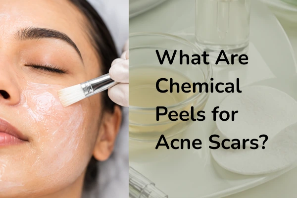 What are chemical peels for acne scars