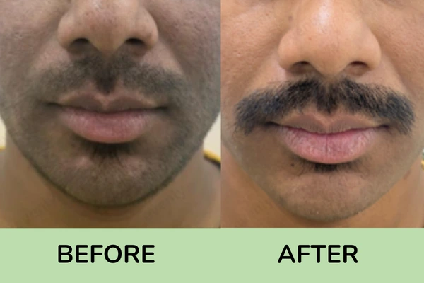 Before and after images of tan removal treatment