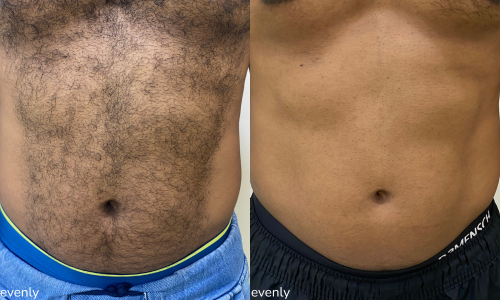 Before and after images of laser hair reduction