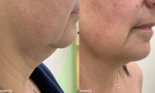 Before and after images of anti-aging treatments in Bangalore
