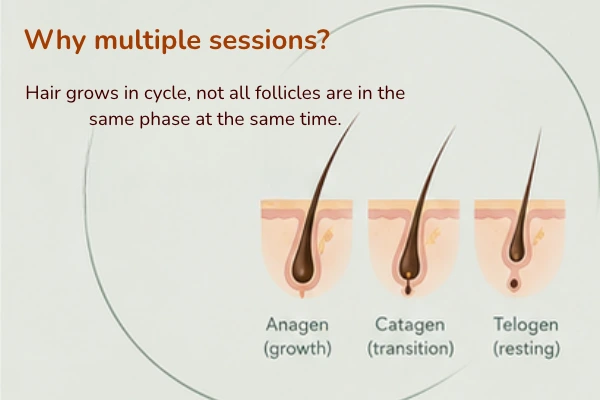 Why laser hair reduction need multiple sessions